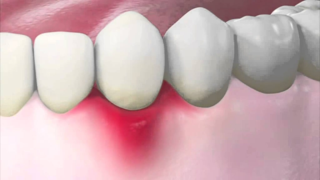 Удаление кисты зуба Томск Производственный стоматология блеск томск официальный сайт