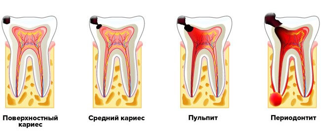 Лечение пульпита Томск Малый трамплин стоматолог общей практики что может делать