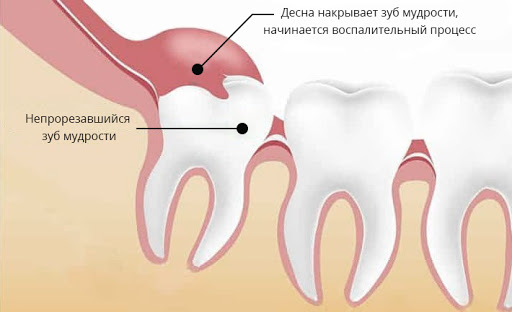 Удаление кисты зуба Томск Производственный здрава стоматология в томске