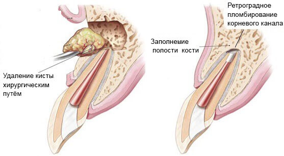 Удаление кисты зуба Томск Приозерная эконом стоматология в томске