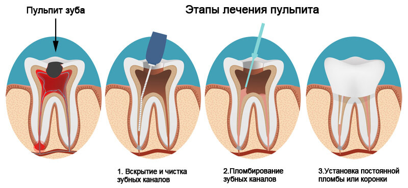 Лечение пульпита Томск Измайловская фабрика улыбок стоматология томск